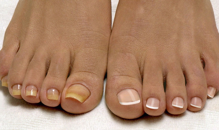 Грибок ногтей на ногах: причины, симптомы и способы лечения