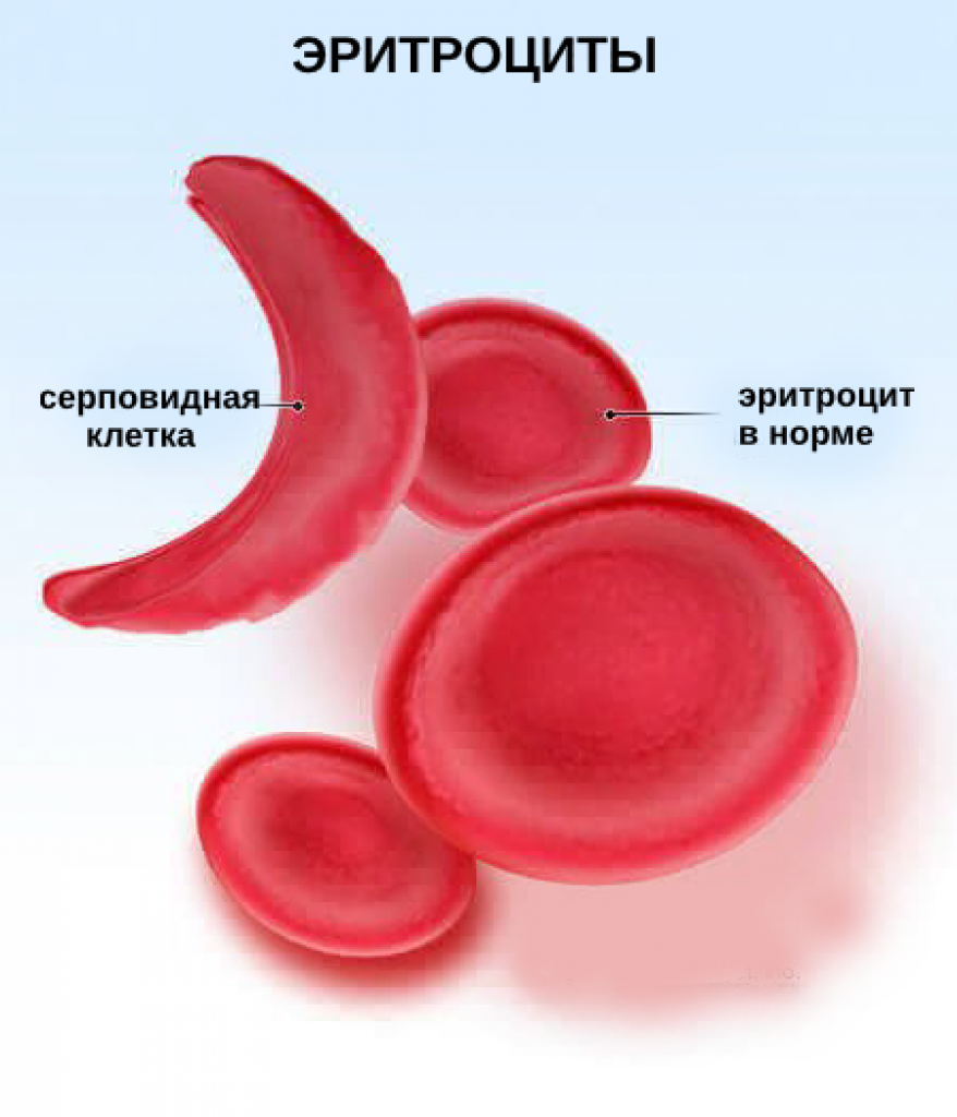 Эритроциты при серповидно клеточной анемии. Серповидноклеточная анемия эритроциты форма. Серповидноклеточная анемия (гемоглобинопатия). Серповидноклеточная анемия гемоглобин s. Эритроциты при серповидноклеточной анемии.