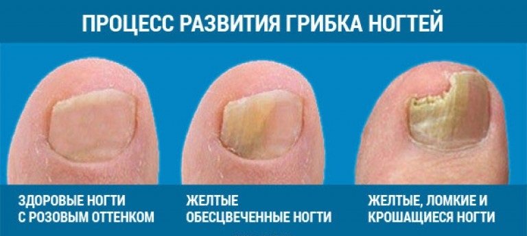 Грибок ногтей на ногах: причины, симптомы и способы лечения