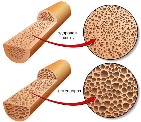 7 важных мер для предотвращения остеопороза