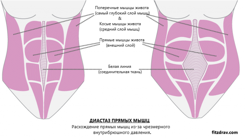 Мышцы живота после беременности. Диастаз прямой мышцы живота. Диастаз прямых мышц живота у женщин. Упражнения при диастазе мышц живота у женщин. Упражнения при диастазе мышц живота у женщин после родов.