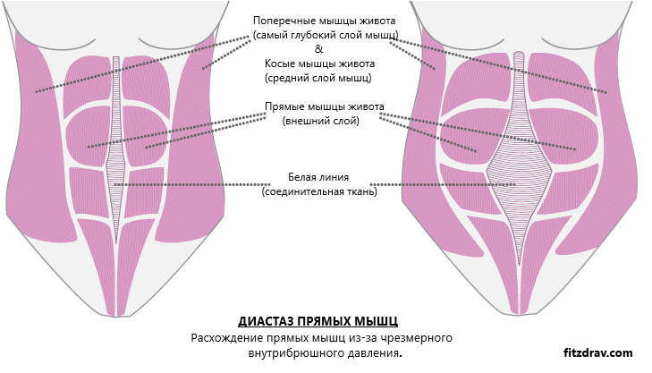 диастаз прямых мышц живота