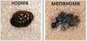 kak-vyglyadit-melanoma